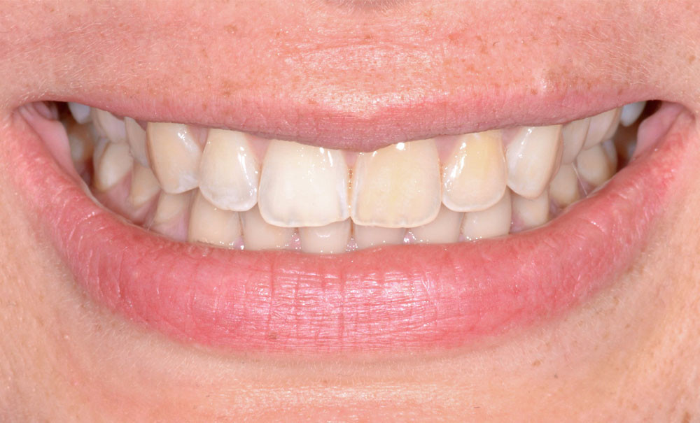 Pronostic du résultat colorimétrique obtenu postéclaircissement des