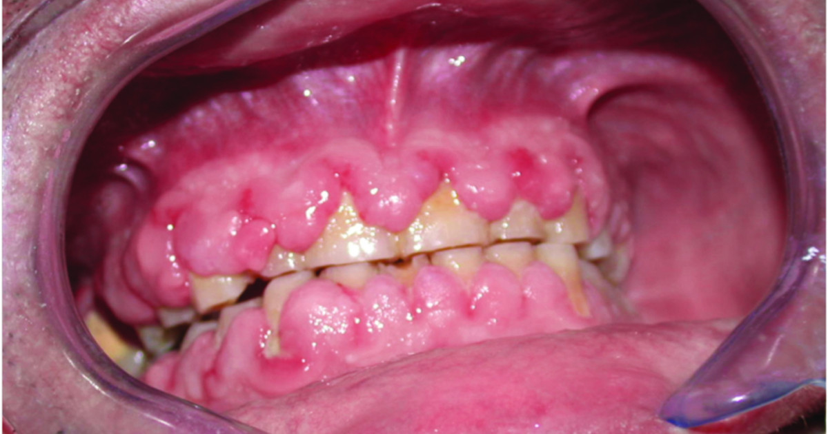 Hypertrophies gingivales – L'Information Dentaire