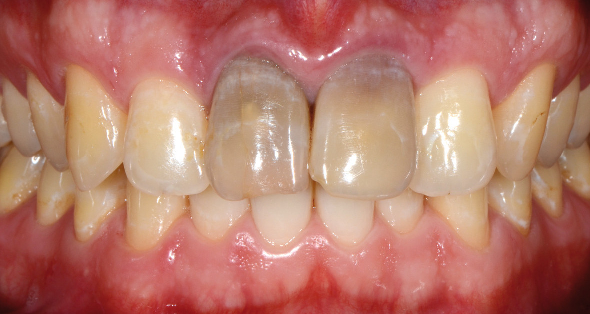 Eclaircissement et consolidation d’une dent dépulpée antérieure