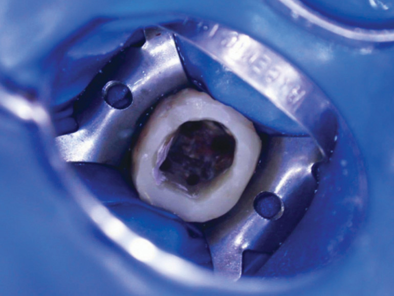 L’obturation endodontique L'Information Dentaire