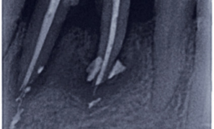 Embouts D'aiguille De Remplissage Endodontique - 1 Pièce/paquet - Pour Dentiste - Neuf