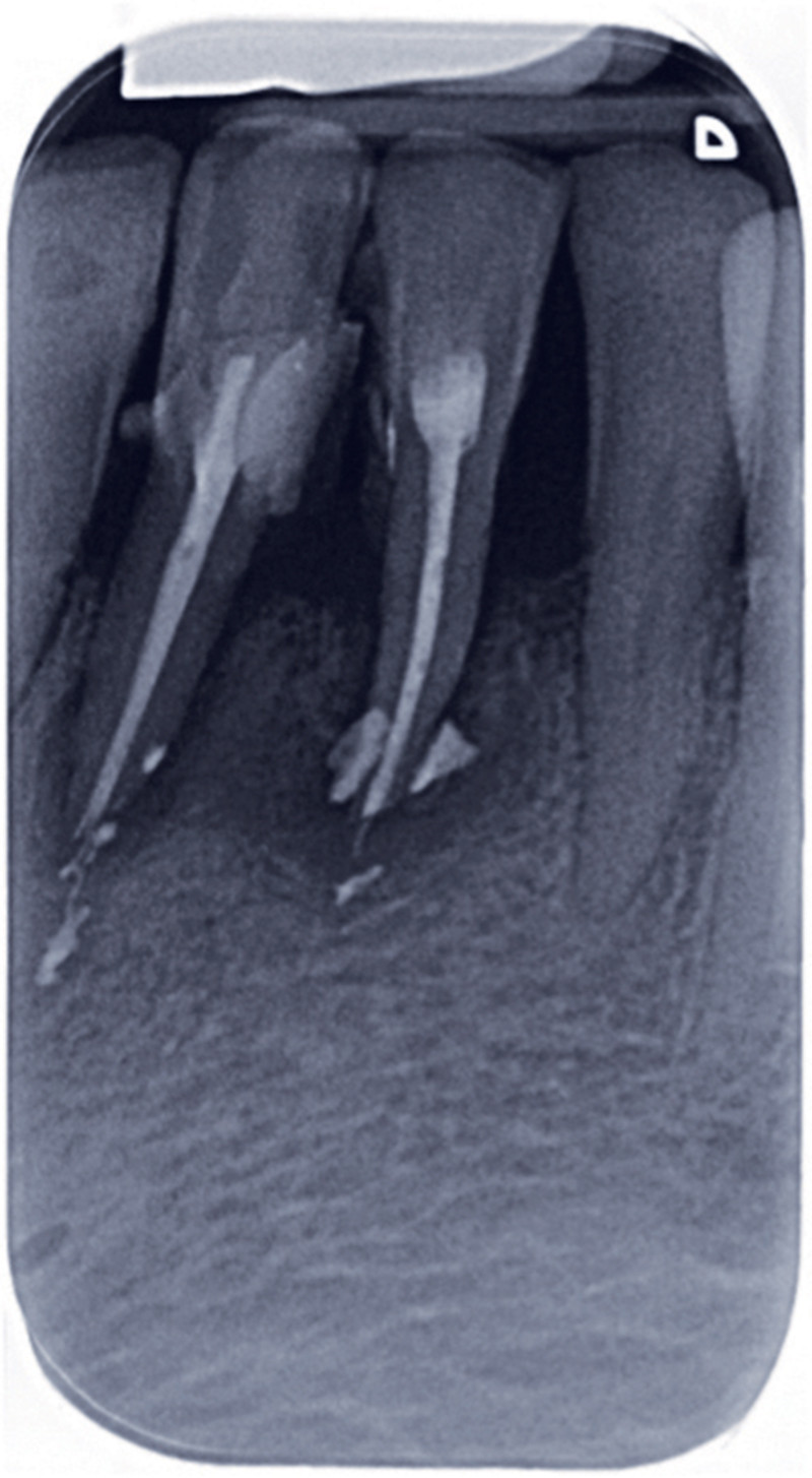 L’obturation endodontique L'Information Dentaire