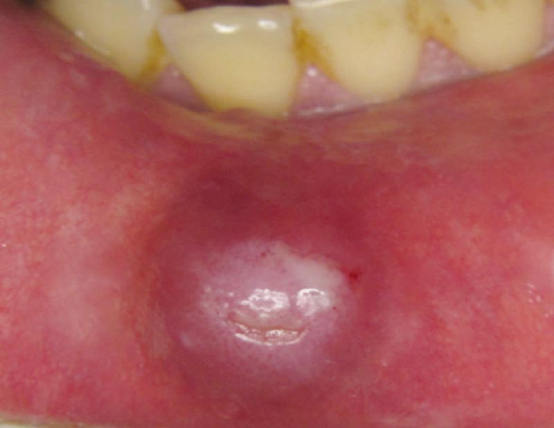 Deux lésions violacées de la lèvre inférieure – L'Information Dentaire