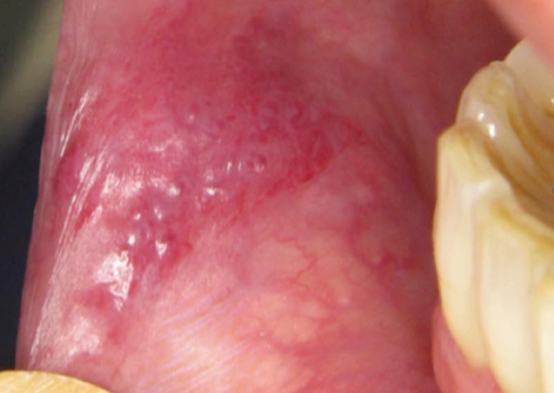 Deux lésions violacées de la lèvre inférieure – L'Information Dentaire