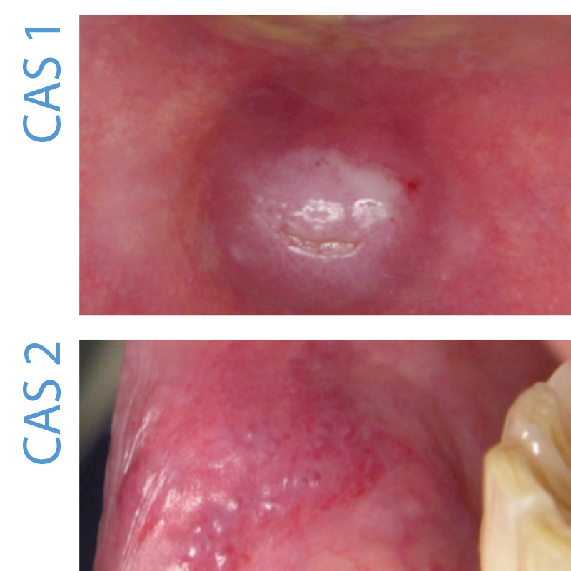 Deux lésions violacées de la lèvre inférieure L