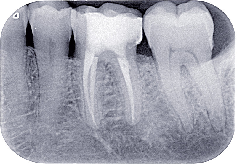 Le continuum endorestaurateur L'Information Dentaire