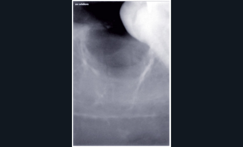 Code Ccam Extraction 4 Dents De Sagesse