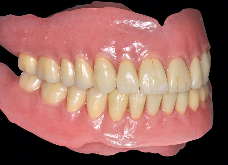 La personnalisation des dents artificielles en résine – L'Information  Dentaire