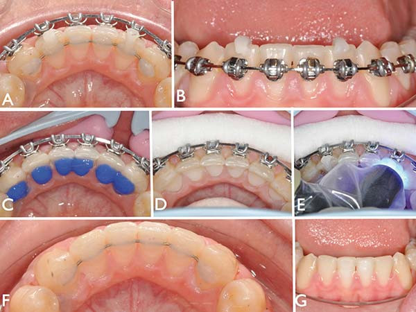 Guide sur les différents appareils en orthodontie chez l'adulte