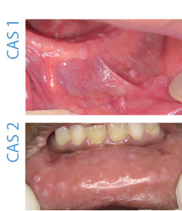 papillomavirus gencive traitement