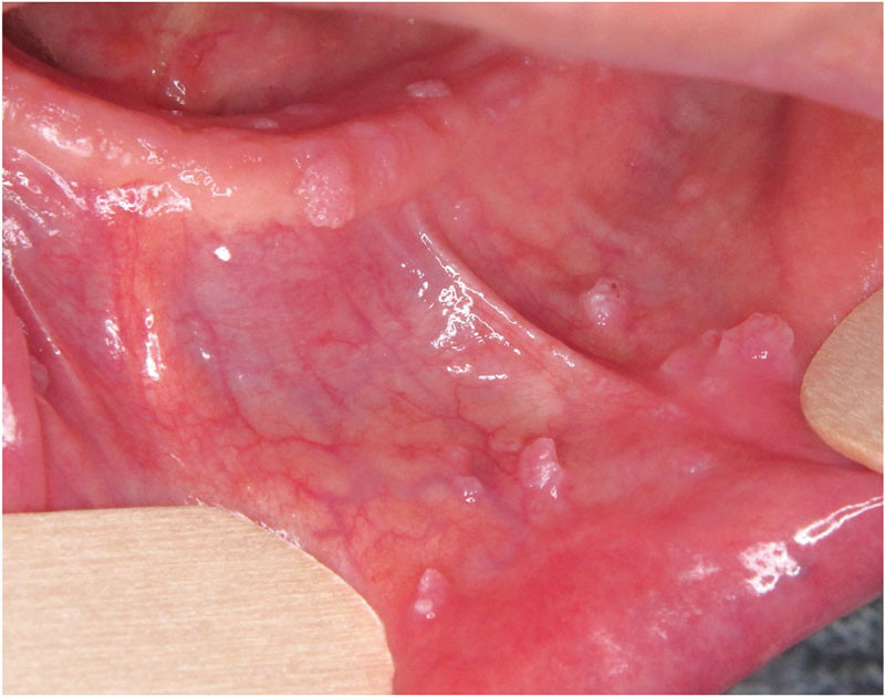 papillomavirus muqueuse bouche