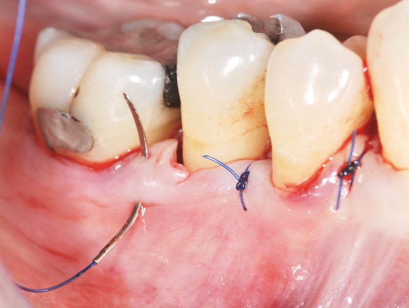Facteurs Accélérant ou Retardant la Cicatrisation parodontal