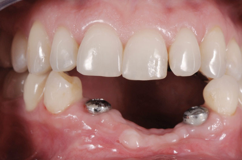 Fausse gencive Nexco sur bridge céramométallique L