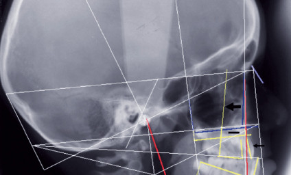 Traitement d’une “classe III” – L'Information Dentaire