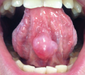 Une « boule » sous la langue – L'Information Dentaire