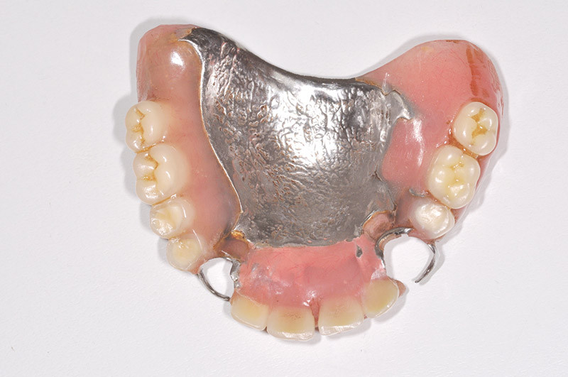 Prothèse dentaire partielle amovible en Espagne - UEDentaire