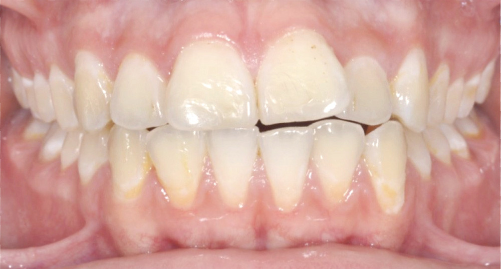 Nettoyer Dent Resine  : Nettoyant Concentré Pour Résine Adoucisseur.