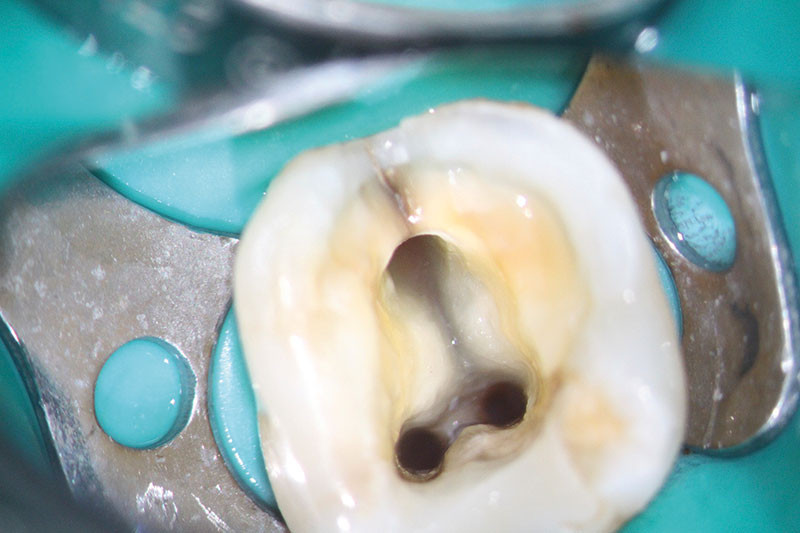 Le microscope opératoire en endodontie L'Information Dentaire