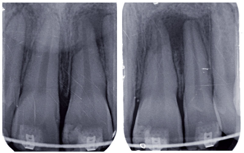 La cicatrisation de la lésion apicale d’origine endodontique L