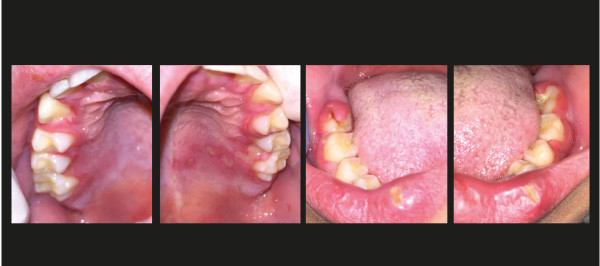Des Lesions Buccales Chez L Enfant L Information Dentaire Des Lesions Buccales Chez L Enfant L Information Dentaire
