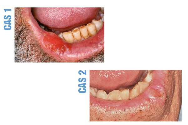 Ulcération chronique de la lèvre – L'Information Dentaire