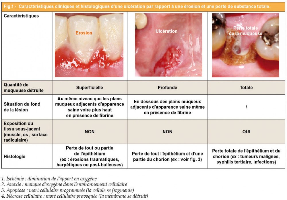 Ulcérations buccales l’arbre décisionnel L'Information Dentaire