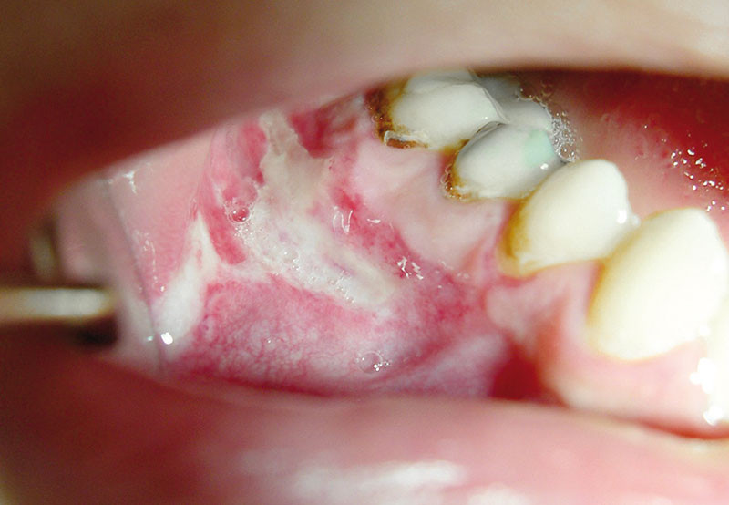 Ulcérations orales d’origine traumatique et iatrogène L'Information