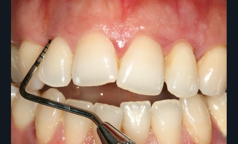 Utilisation Raisonnee Des Antibiotiques En Parodontologie L Information Dentaire