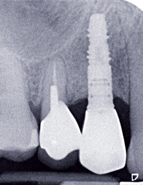 GDT Cubes Os Synthétique Résorbable - Remplacement Osseux Pour Greffe Dentaire, 100% Biocompatible