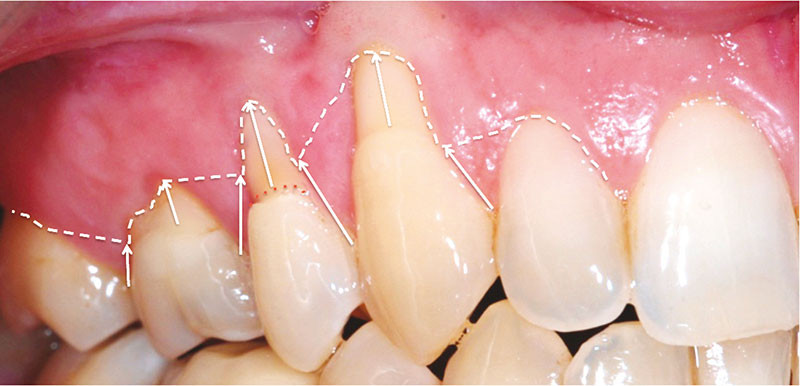 Recouvrement De Recessions Gingivales De Classe I De Miller Avec Lesions Cervicales D Usures L Information Dentaire Recouvrement De Recessions Gingivales De Classe I De Miller Avec Lesions Cervicales D Usures L Information Dentaire