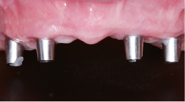 Réhabilitation complète - Parodontite, extraction des dents, pose des  implants, pose des prothèse sur barre de rétention (Présentation de cas)  (55)