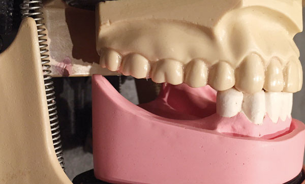 Prothèse amovible partielle prix - Prothèse amovible partielle - Dentego