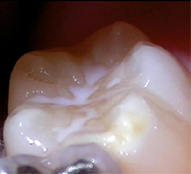 L’hypominéralisation molairesincisives MIH L