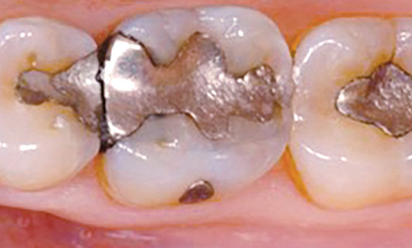 Histoire du « plombage dentaire » – L'Information Dentaire