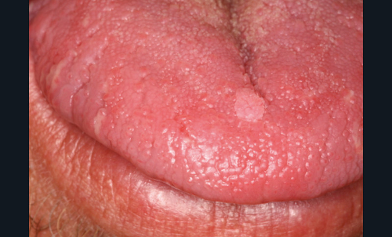 lesion hpv langue