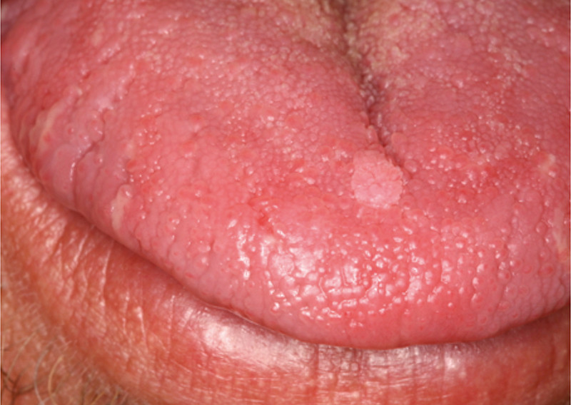 Papillomavirus et langue. Papillomavirus chien langue.