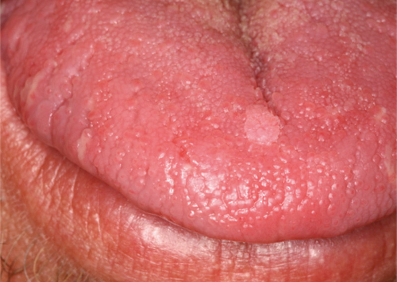 Hpv throat cancer blogs. Papilloma of breast duct