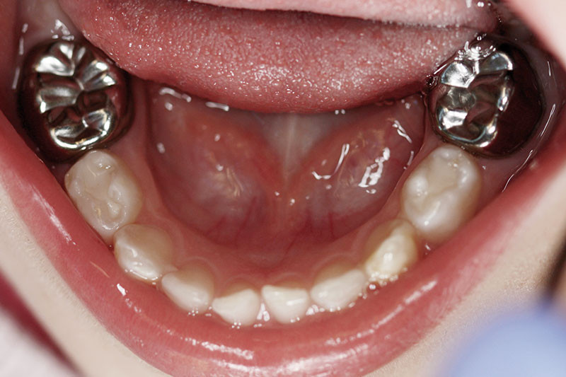 Les couronnes pédiatriques préformées esthétiques sur molaires temporaires  : quelles sont les nouveautés ? – L'Information Dentaire