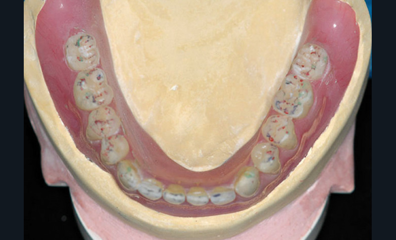 La prothèse amovible complète – L'Information Dentaire