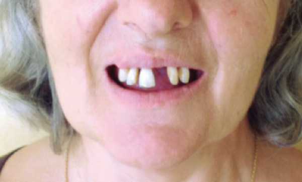 Prothese Amovible Et Esthetique L Information Dentaire