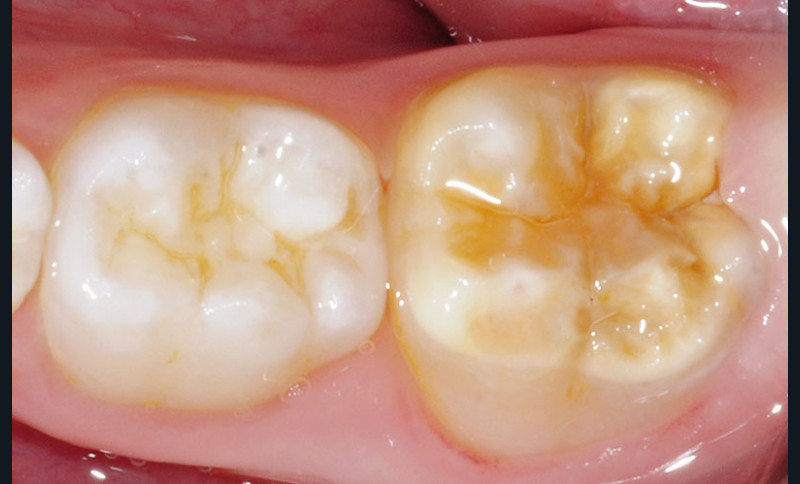 Decoder Les Mih L Information Dentaire
