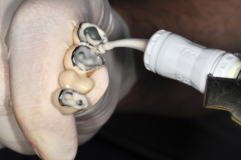 Cimentation de couronne dentaire : Comment réduire l'excès de ciment ?