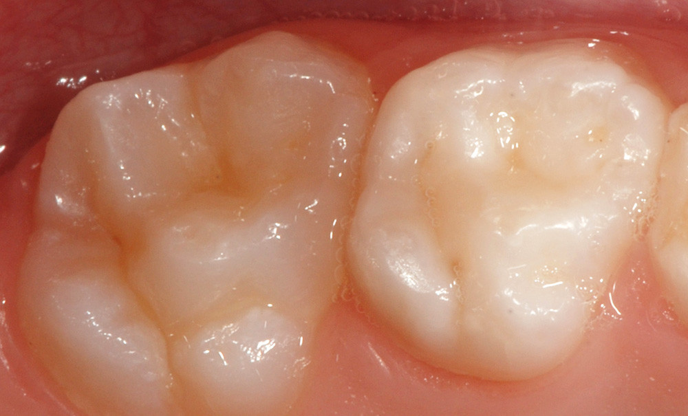Les hypominéralisations, un nouveau défi pour le praticien L