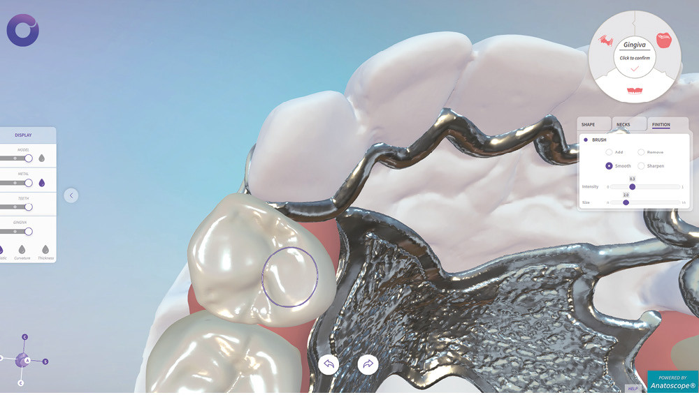 L’apport de la CFAO en prothèse amovible partielle à châssis métallique