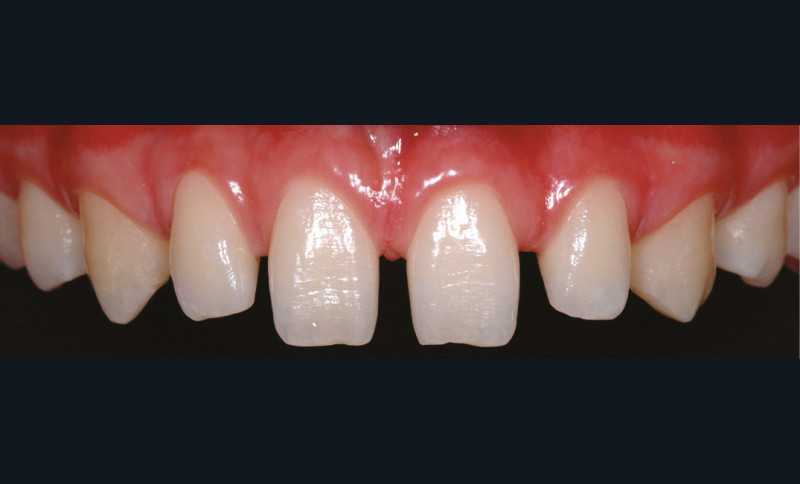 Composite une face ccam