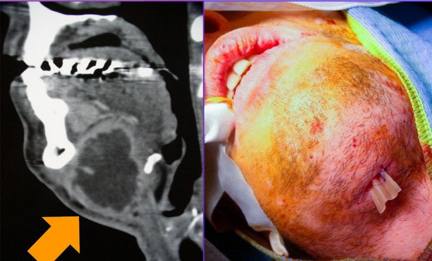 Cellulites Cervico Faciales Et Hospitalisation D Urgence L Information Dentaire Cellulites Cervico Faciales Et Hospitalisation D Urgence L Information Dentaire