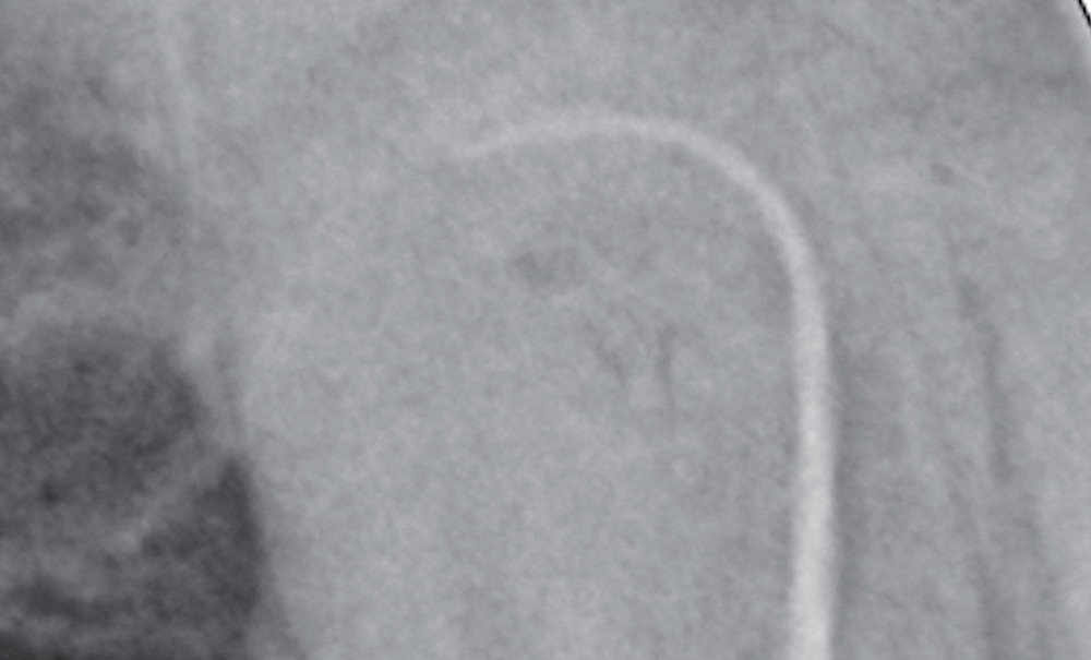 12 Pinces à Pansement Dentaires 6 Pouces - Acier Inoxydable Chirurgical, Autoclavables, Endodontie