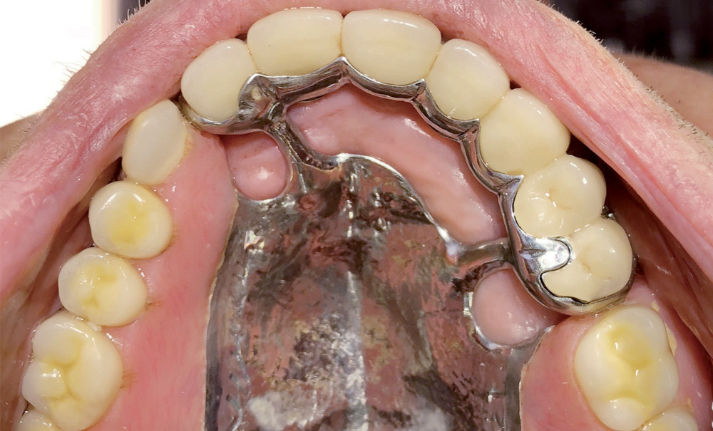 Prothèse amovible partielle combinée : à propos d'un cas clinique –  L'Information Dentaire