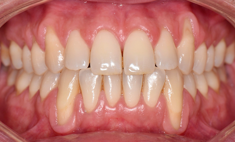 Dent En Plastique  . Dent En Hélice Sens Vertical.