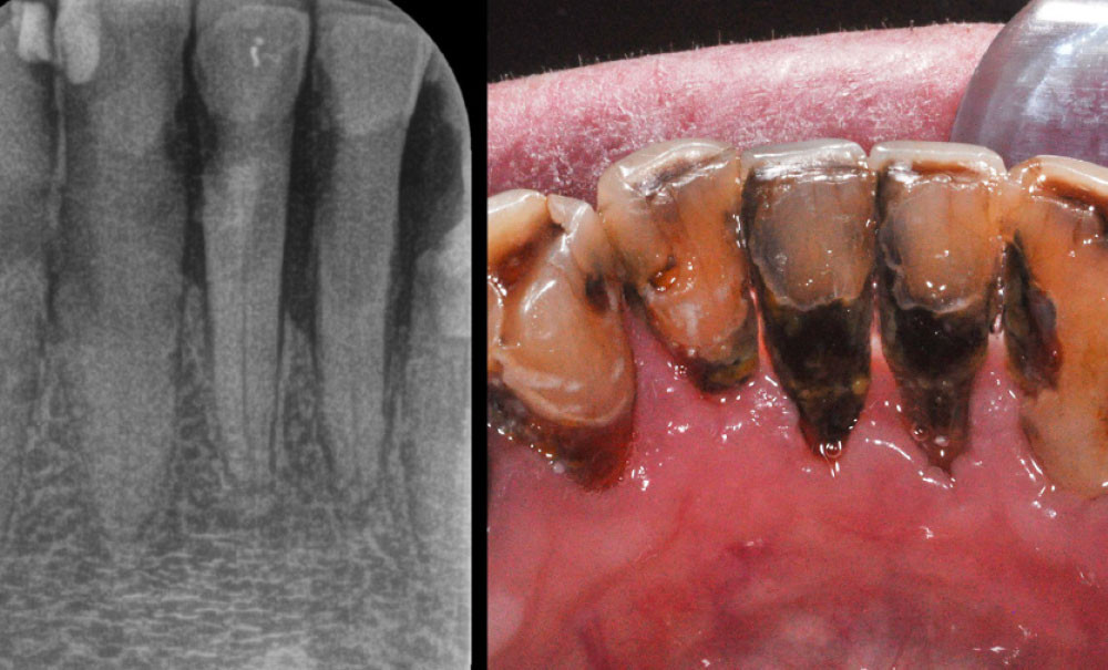 Prévention et traitement des caries radiculaires L'Information Dentaire